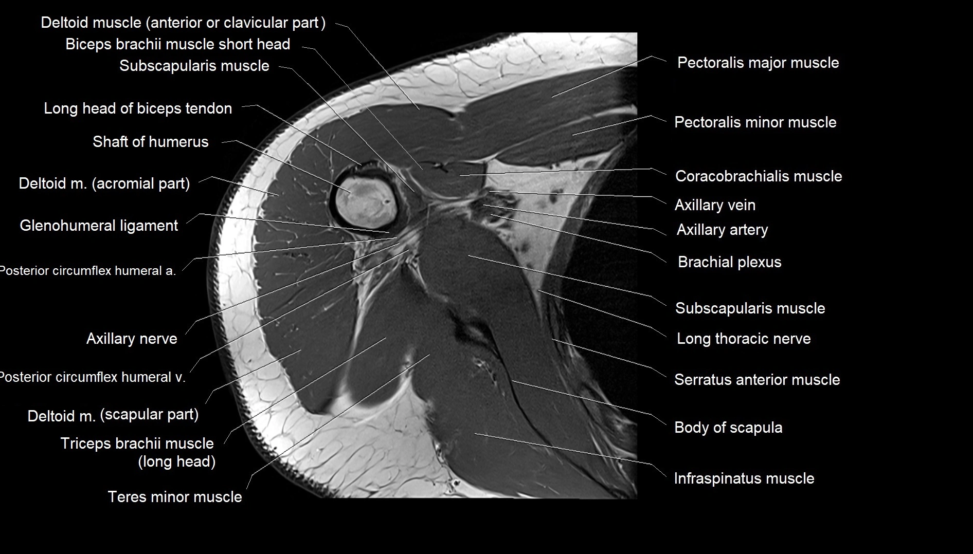 Shoulder cross sectional anatomy MRI 3T axial image 30.webp